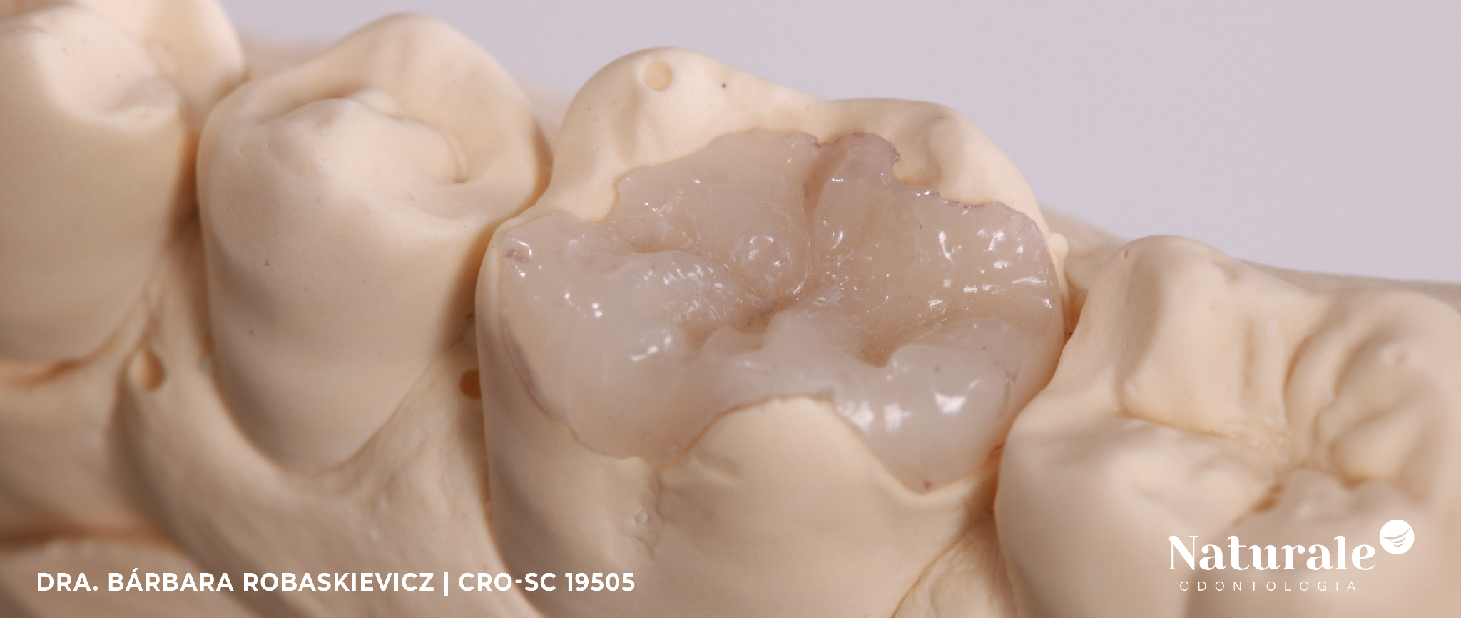 Restauração de dente posterior: estética e função.