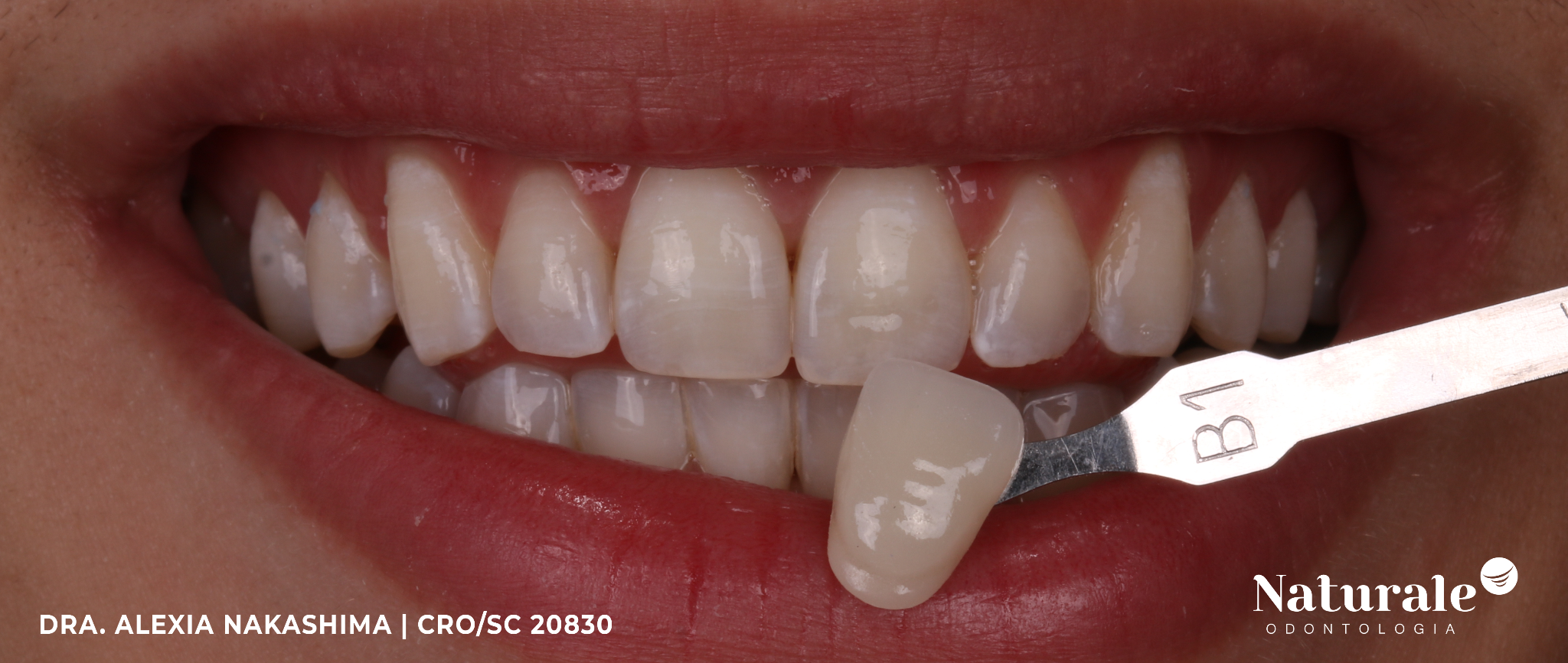 Caso clínico: clareamento dental